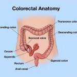Colon and Rectal Cancer