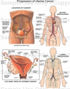 Uterine Cancer